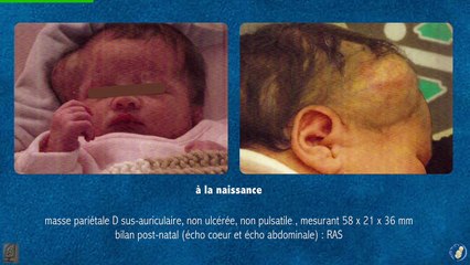 Hémangiome de la face : diagnostic et prise en charge pré- et post-natale