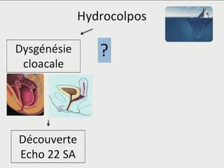 Fetal MRI compared to Ultrasonography in the diagnosis of obstructive urogenital malformations.