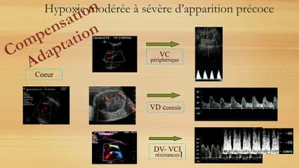 Doppler du foetus : RCIU