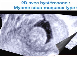 Imagerie des myomes:Apport de l’échographie