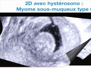 Imagerie des myomes:Apport de l’échographie