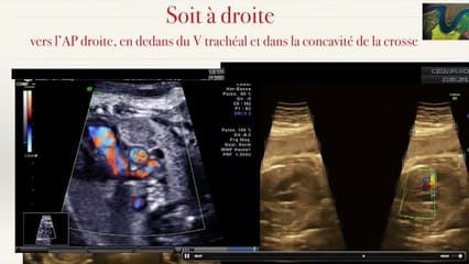 COEUR Le canal artériel dans tous ses états