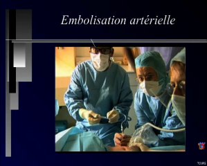 Les chorioangiomes : l’embolisation