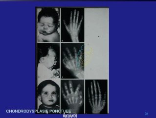 Aspect clinique des chondrodysplasies