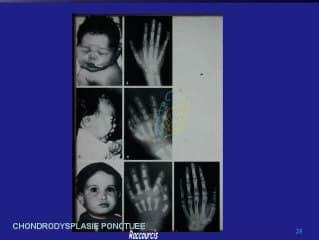 Aspect clinique des chondrodysplasies