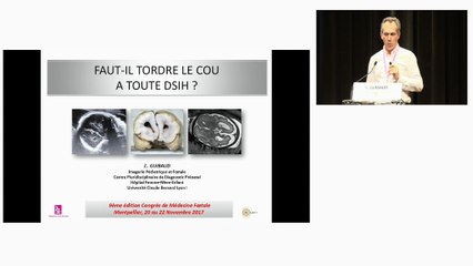 Faut-il tordre le cou à toute distorsion de la scissure Inter-hémisphérique ?