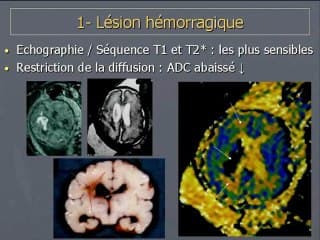 La diffusion cérébrale foetale pour les nuls