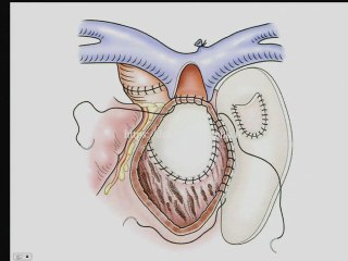 Transposition des gros vaisseaux : éléments de décision