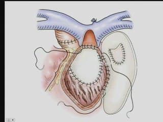 Transposition des gros vaisseaux : éléments de décision