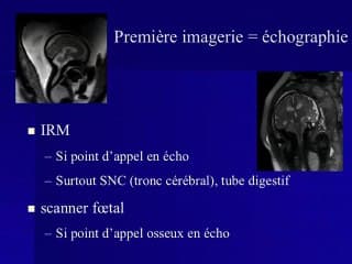 Tout ce que vous voulez savoir sur l'hydramnios