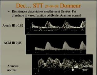 STT syndrome transfuseur transfuse