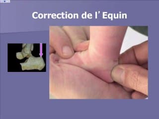 Kine_sithe_rapie et pied bot