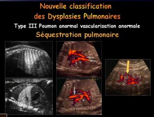 Sémiologie échographique des dysplasies pulmonaires