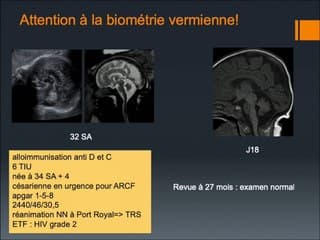 Apport de l’IRM dans les anomalies a fosse postérieure.