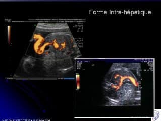 Persistance de la veine ombilicale droite