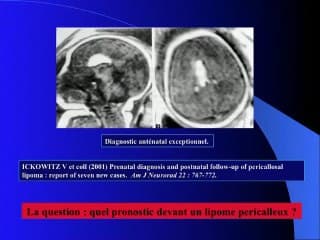 lipome du corps calleux