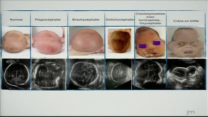 Reconnaitre les profils "syndromiques"