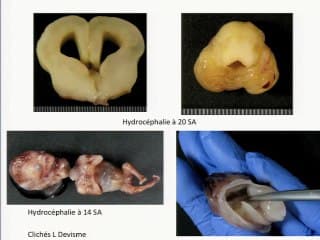 Quel avenir pour l'échographie du 1er trimestre en 2013