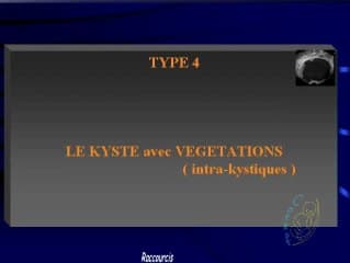 Les masses annexielles