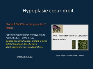 hypolasie cœur drt