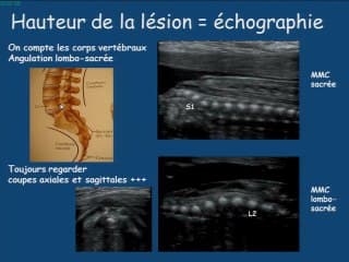 imagerie des myeloméningoceles