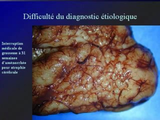 Confrontations foetopathologiques : en sus tentoriel :