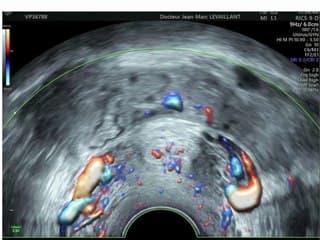 Coupe systématique des ligaments utero sacrés