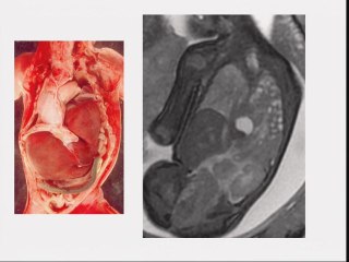 irm du diaphragme