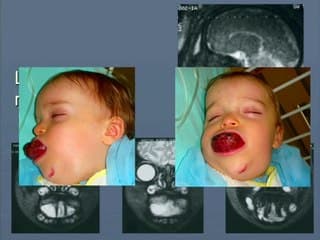 Imagerie des masses oropharyngées*