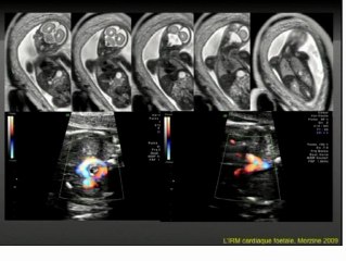 Apport actuel et futur de l'IRM cardiaque foetale