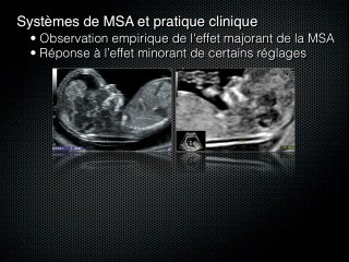 Mesure automatique de la clarté nucale : impact sur les résultats