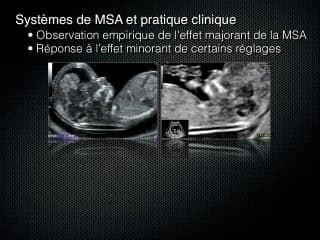 Mesure automatique de la clarté nucale : impact sur les résultats