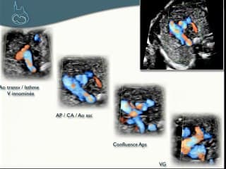 L' examen du coeur : Etude détaillée des coupes des 3 vaisseaux : topo