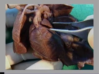 Foetopathologie et cœur