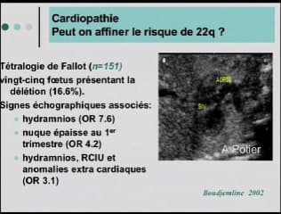 Quand rechercher une délétion 22q11 en anténatal ?