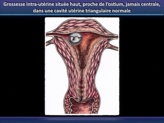 Grossesse extra-utérine GEU extra-tubaire : diagnostic et prise en charge thérapeutique