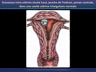 Grossesse extra-utérine GEU extra-tubaire : diagnostic et prise en charge thérapeutique