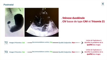 Pourquoi loupons-nous encore des malformations cardiaques congénitales en 2021 ?