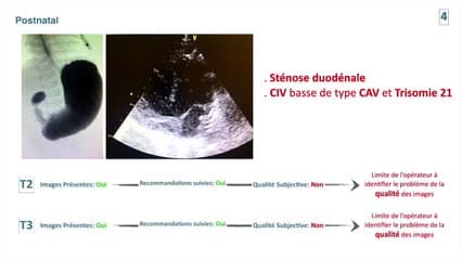 Pourquoi loupons-nous encore des malformations cardiaques congénitales en 2021 ?