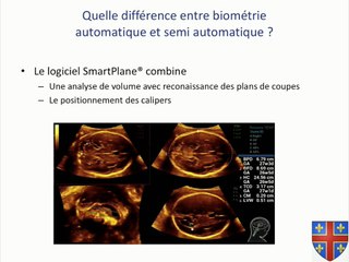 36 L'intelligence artificielle pour la biométrie céphalique à partir de volumes échographiques