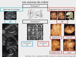 POSTER Sutures du Crâne