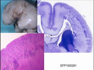Syndromes et anomalies de l'oeil