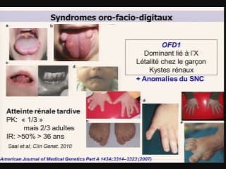 Les ciliopathies rénales - de la génétique au phénotype.