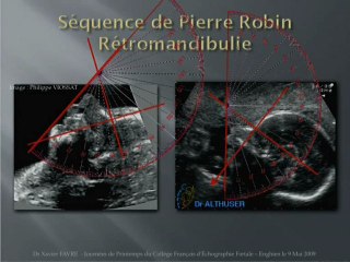 Dépistage des malformations de la face : Images et performances de l’échographie prénatale.