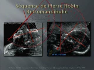 Dépistage des malformations de la face : Images et performances de l’échographie prénatale.