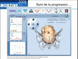 Place de l’échographie en salle de naissance