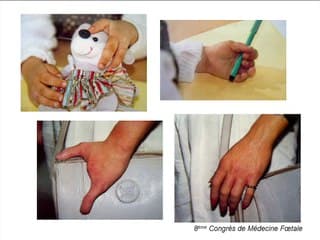 Traitement et évaluation pronostique des malformations des membres.