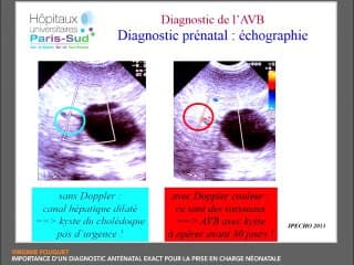 Les experts errent aussi : appareil digestif Importance d'un diagnostic anténatal exact pour la prise en charge néonatale