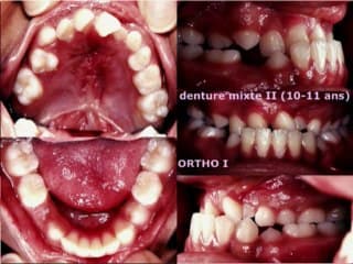 Fente labio-palatine Prise en charge orthodontique