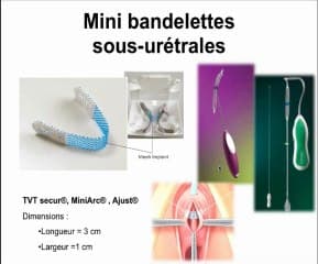 3D ET NOUVELLES APPROCHES EN ÉCHOGRAPHIE GYNÉCOLOGIQUE Le périnée en échographie : nouvelle approche de la statique pelvienne et nouvelle évaluation des résultats de la chirurgie urinaire et prothétique.